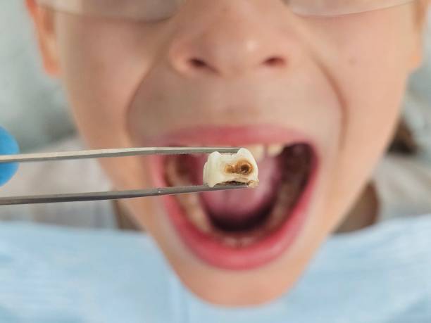 Best Emergency Tooth Extraction in Perry, KS